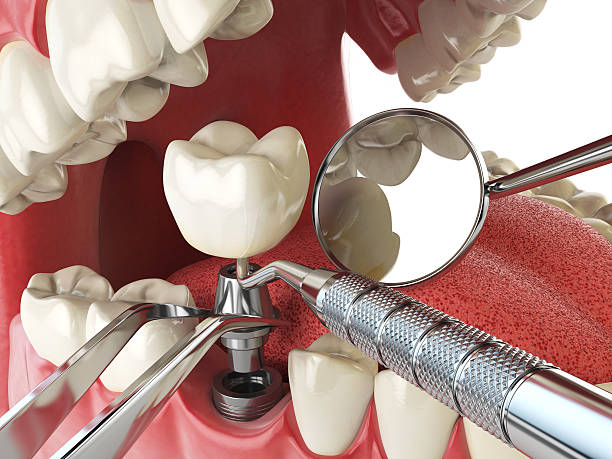 Best Dental Abscess Treatment in Burbank, CA